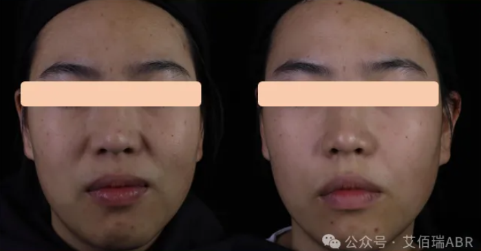 国内首创——天然交联胶原纤维填充剂-Ⅲ 临床试验入组圆满完成